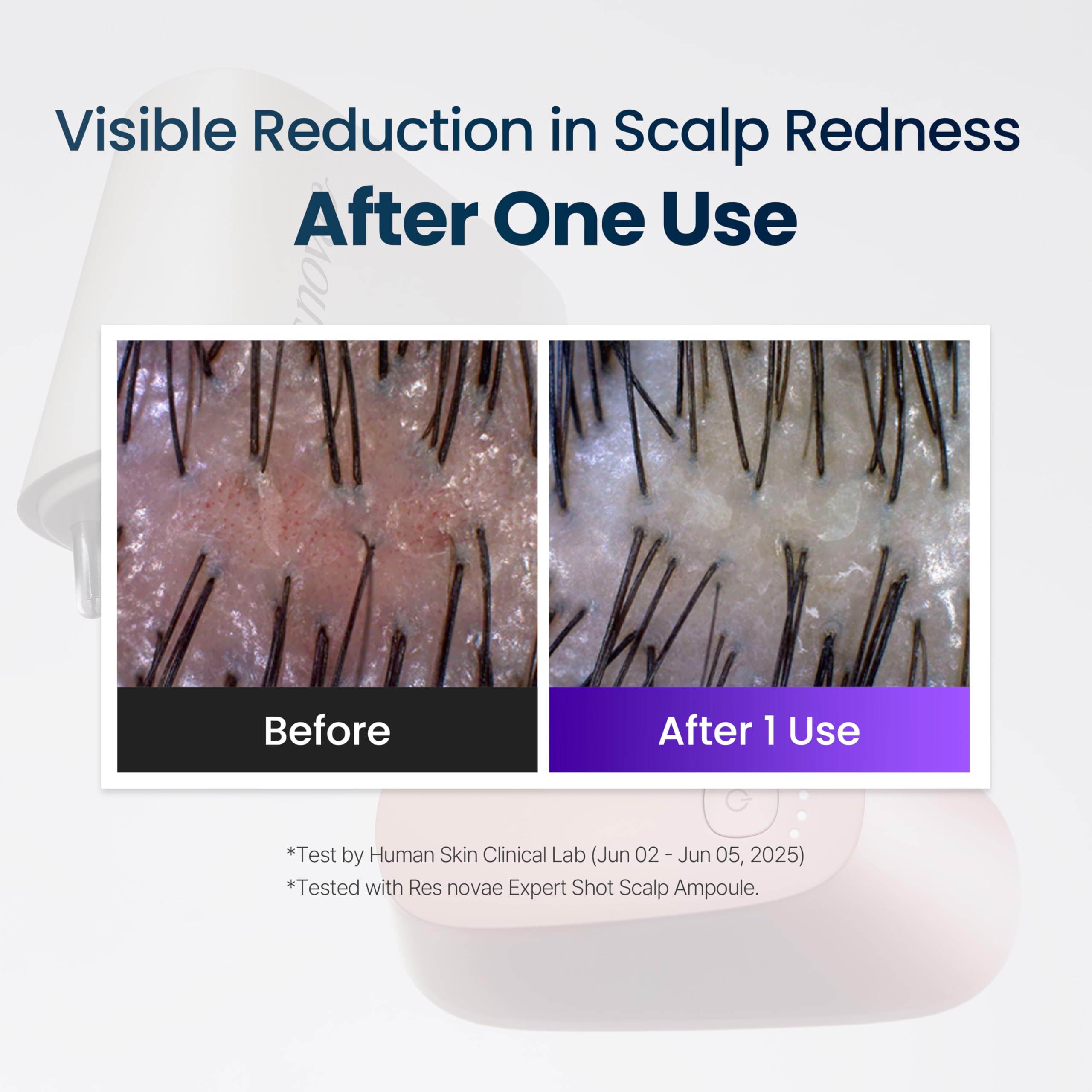 Scalp Care Device for Massage & Serum Absorption